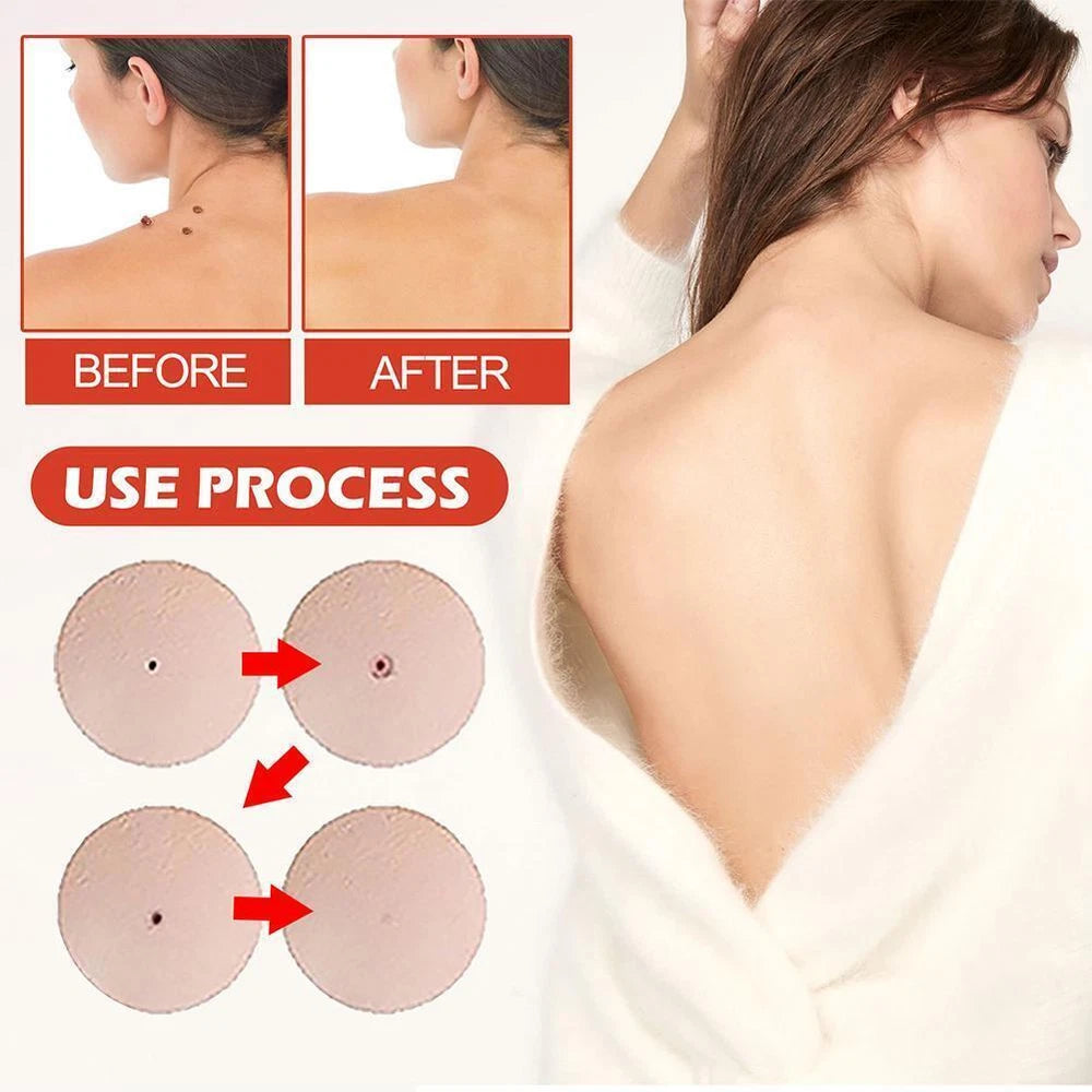DermaDot™ MicroDarts – Smärtfri borttagning av hudflikar