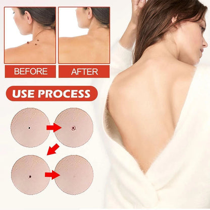 DermaDot™ MicroDarts – Smärtfri borttagning av hudflikar